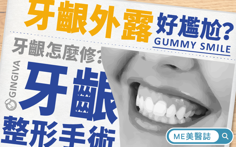 一笑就露牙齦，讓你不敢大笑？來看牙齦外露手術怎麼改善「露齦笑」！