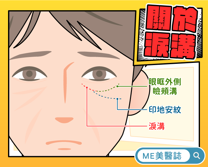 圖說：淚溝是位於眼袋下面跟蘋果肌上方的結締組織，會在周圍組織隨著老化凸出後，凹陷變得更加明顯。