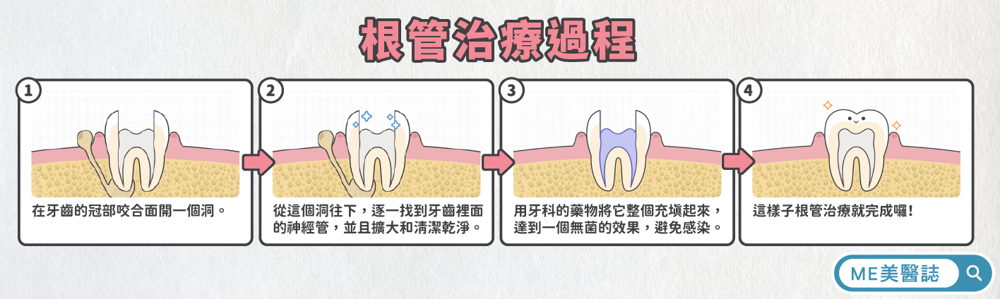 根管治療過程