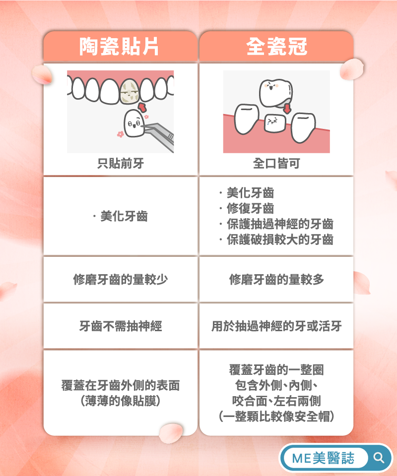 陶瓷貼片、全瓷冠差在哪