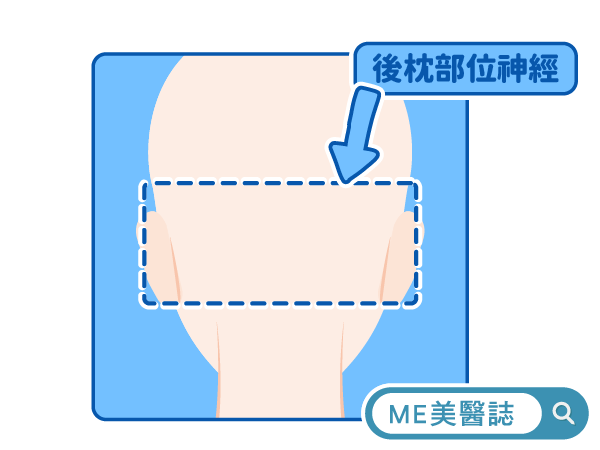 偏頭痛手術