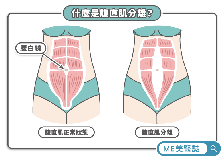 腹直肌分離