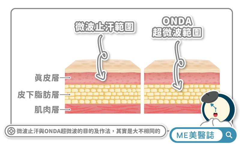 ONDA超微波、微波止汗差別