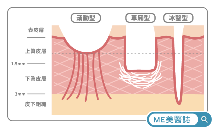 凹痘疤類型比較