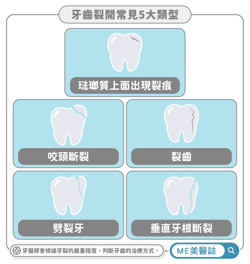 五種常見牙裂類型