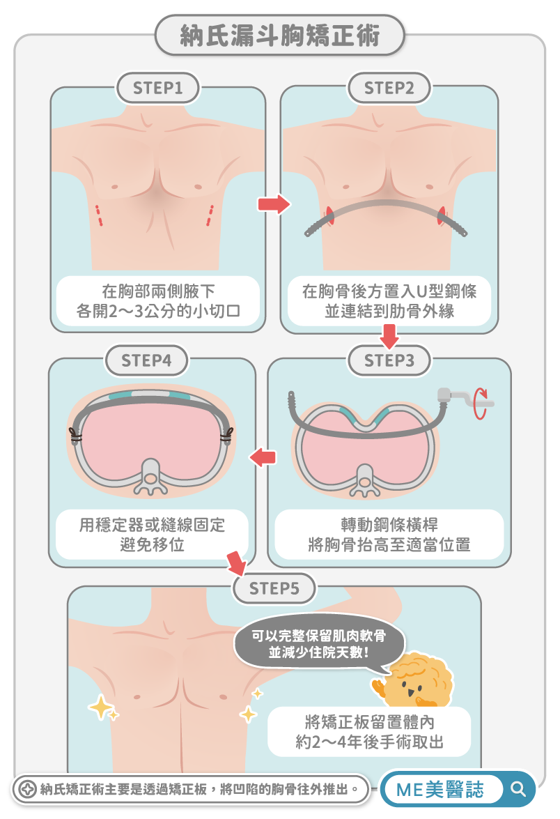 納氏漏斗胸矯正手術