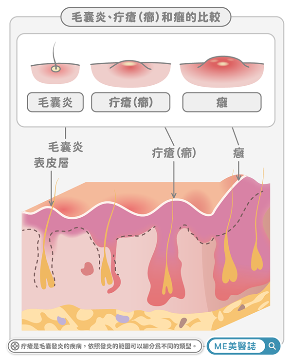疔瘡、癤、癰的比較