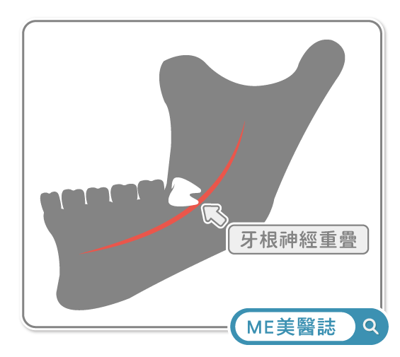拔智齒手術影像評估示意