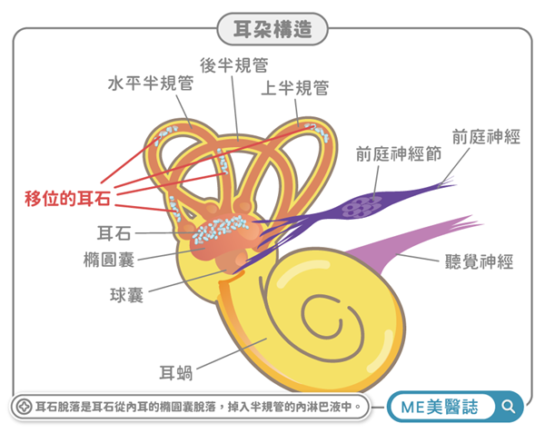耳石脫落原理示意圖