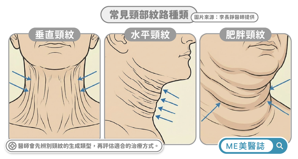 常見的頸紋分類