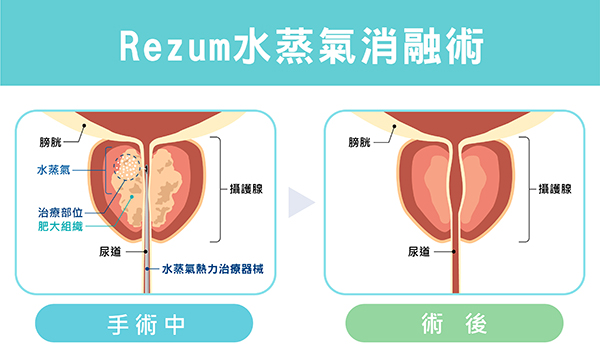 攝護腺肥大治療