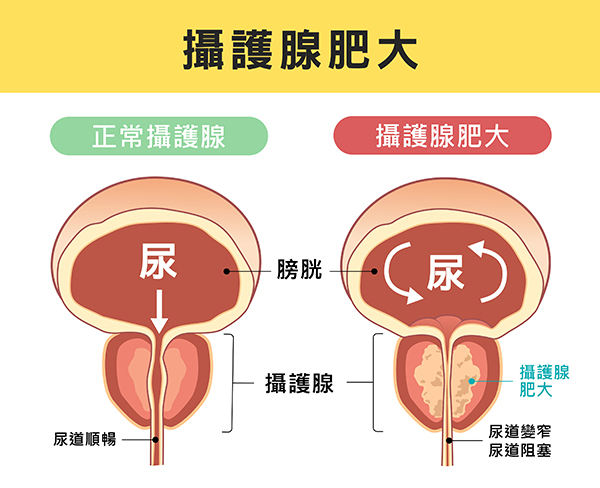 攝護腺肥大治療