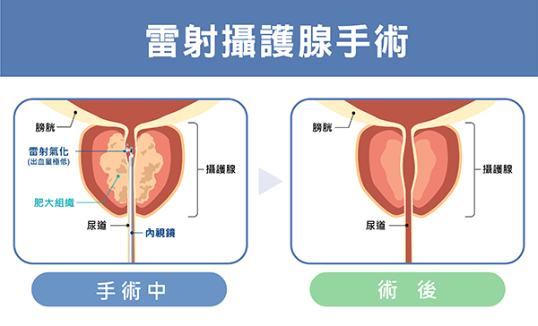 攝護腺肥大治療