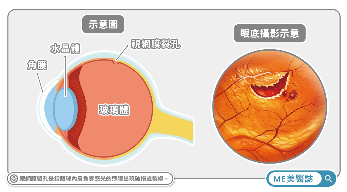 視網膜