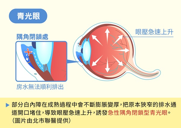 急性隅角閉鎖型青光眼