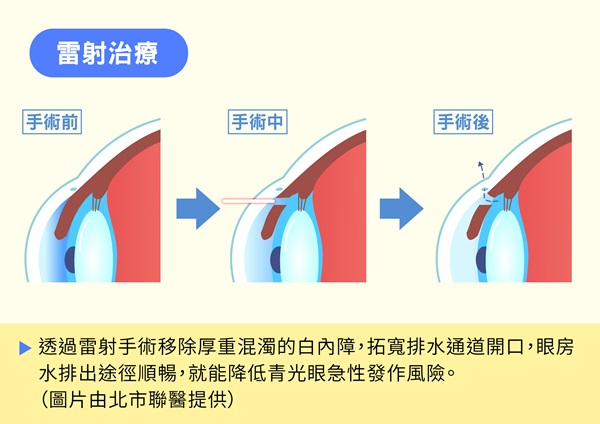白內障微創手術