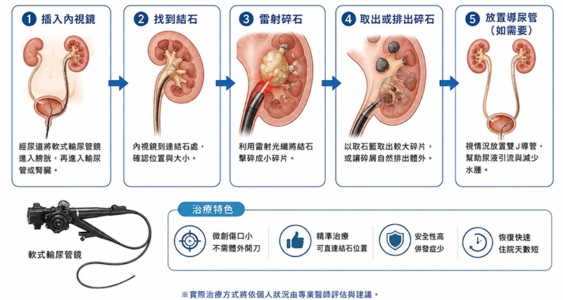 軟式輸尿管鏡碎石治療方法