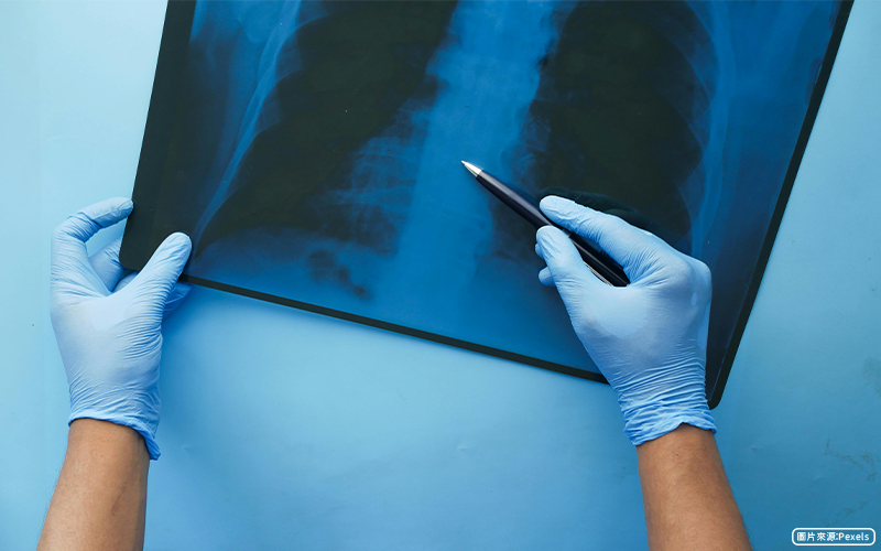 低劑量電腦斷層篩檢，早期揪出肺癌關鍵